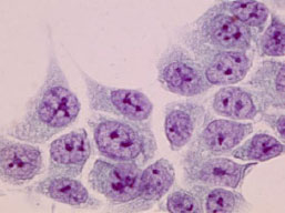 大腸がん細胞