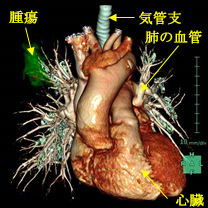 肺の血管画像