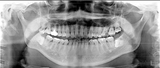 歯の全体写真（パノラマ写真）