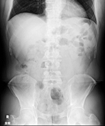 腹部X線画像